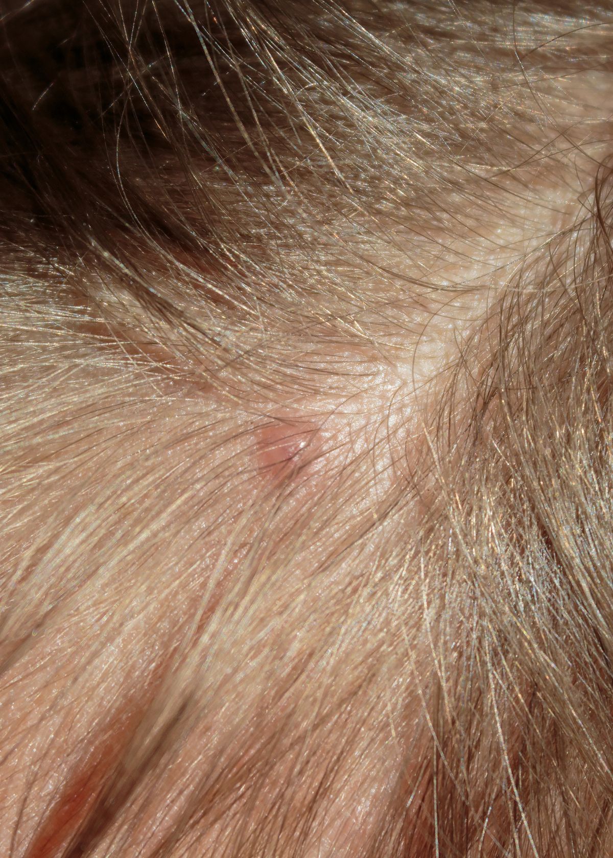 why-you-re-getting-pimples-on-your-scalp-and-how-to-treat-them