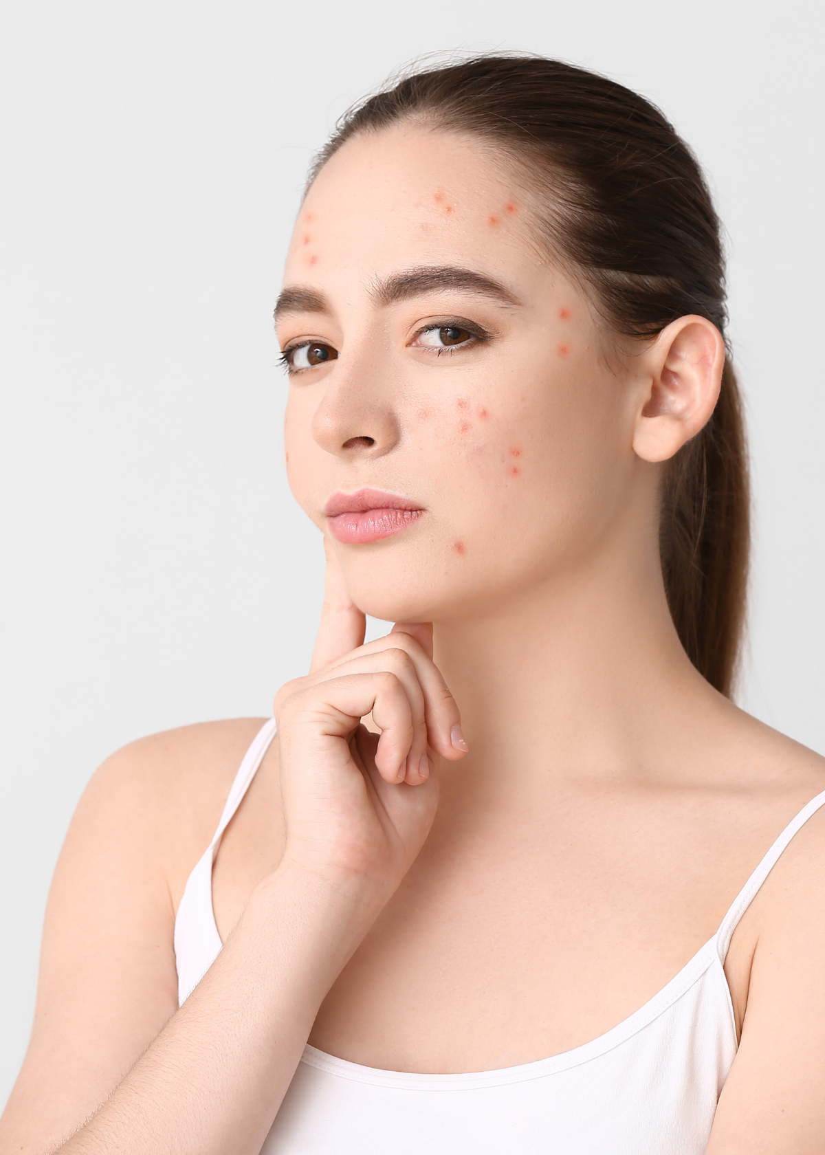 15 Best Moisturizers For Fungal Acne And Soothing Your Skin